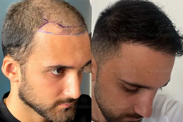 Worbimed | Hair Transplant Turkey Istanbul | Eyebrow Transplant | Beard Transplant