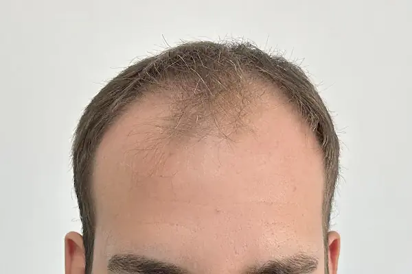 İbrahim Erayhan-Saç Ekimi-Bursa Tıp Merkezi - Hairtransplant Clinic