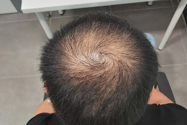 Aydin_arslanclinik saç sorunları