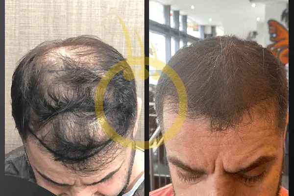 One Hair Clinic Transplantation - Plastic Esthetic