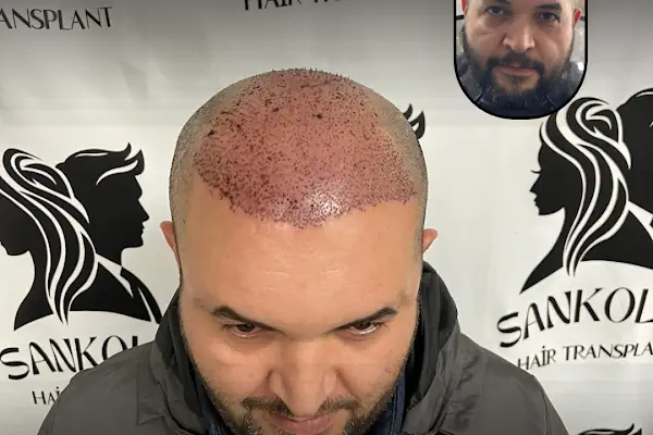 Sankolis İstanbul Hair Transplant - Saç Ekimi İstanbul
