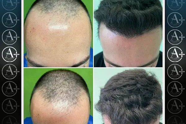 Mediavrupa Saç Ekim | Hair Transplant Turkey Istanbul | Saç Ekim Merkezi İstanbul | FUE Saç Ekimi | DHİ Saç Ekimi |
