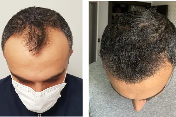 Клиника по пересадке волос Анталья VIVAEST - Saç Ekimi - Hair Transplant Antalya