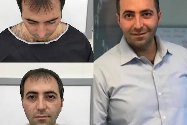 Capillum Clinic Saç Ekimi ve Saç Sağlığı Merkezi