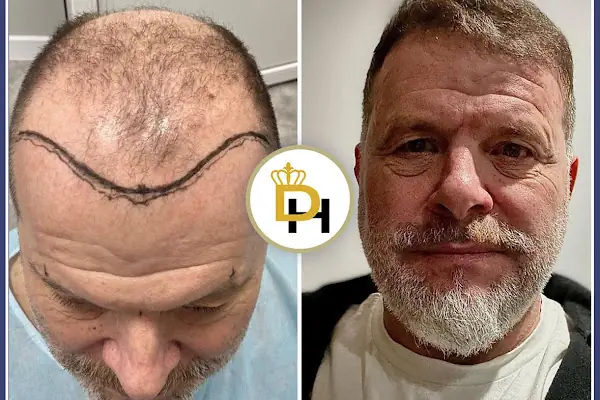 Gaziantep Fue Saç Ekim - Docshair Arif UĞUR