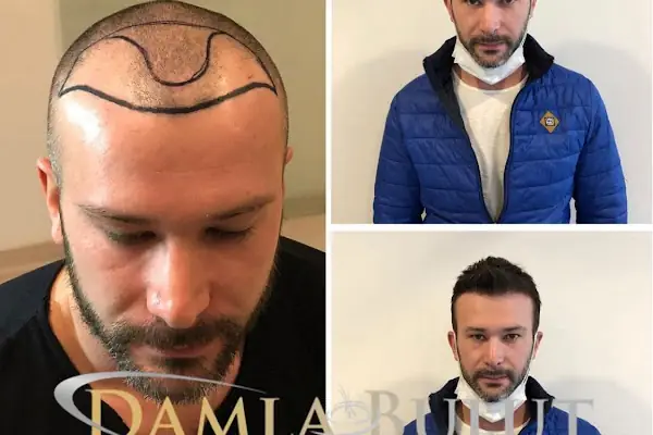 Damlabuluthairtrans Saç Ekim Kliniği