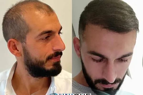 Unique Hair Transplant