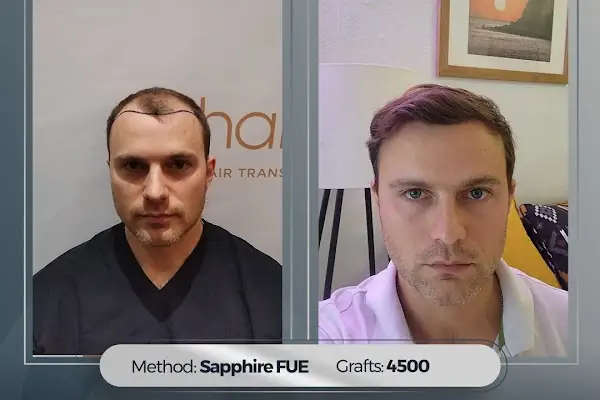 Hairpol | Hair Transplant Clinic (Saç Ekimi Kliniği)