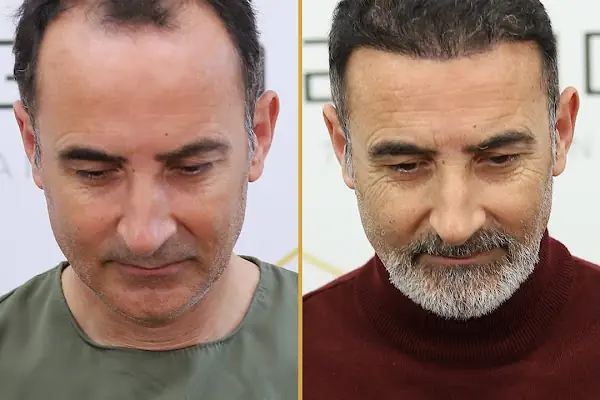 For Legend Hair Transplant