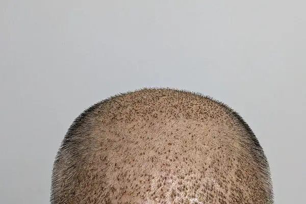 Double Hair Center | Saç Ekim Merkezi
