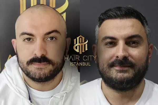 Hair City İstanbul Saç Ekimi