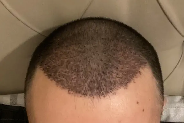 SE Hair Clinic | Hair Transplant Antalya