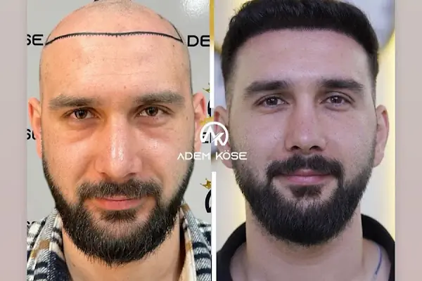 Adem Köse - Hair Transplant Turkey