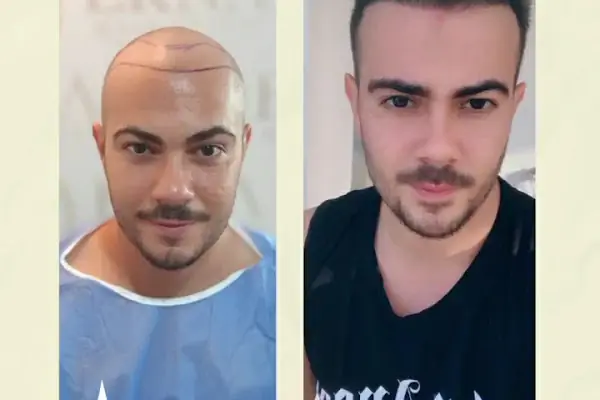 Erna Hair Clinic İzmir Saç Ekim Merkezi