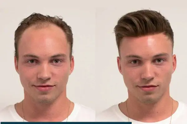 Alanya hairtransplant and prosthetic hair Center ( Alanya saç ekimi ve protez saç merkezi )