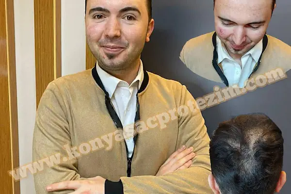Nafiz Keskin Protez Saç Kliniği
