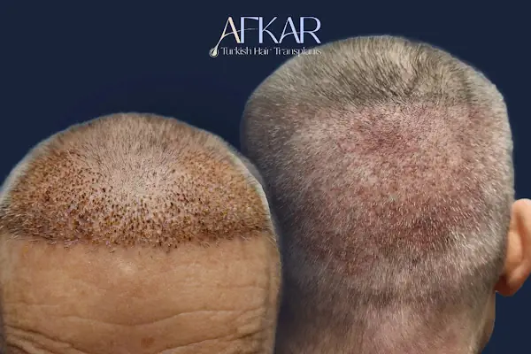 Turkish Hair Transplants - AFKAR - Hair Transplant Turkey, Istanbul