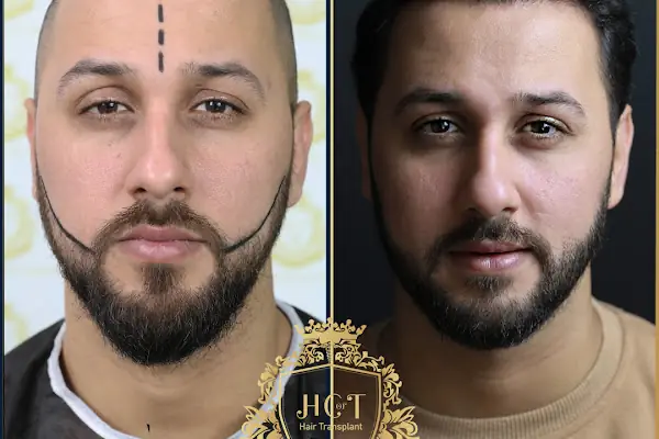 HIV Positive Hair Transplant in Turkey