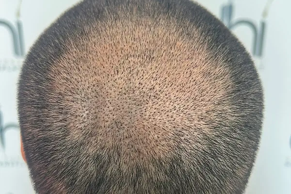 DHI Clinic Turkey - VIP DHI Hair Transplantation