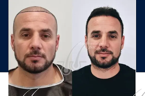 Hair Information Clinic - Saç Ekimi