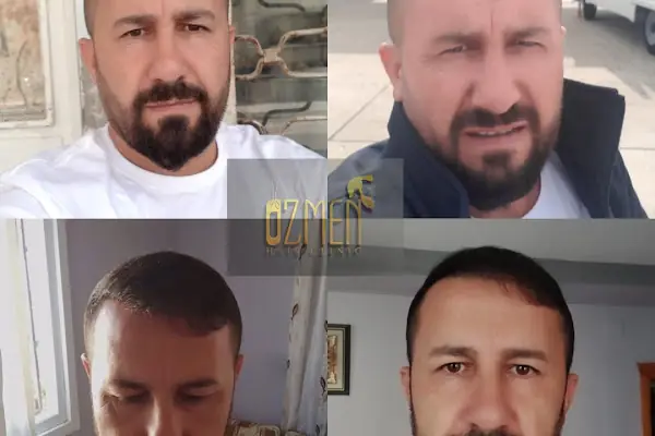 Özmen Saç Ekim , Estetik Ve Güzellik Merkezi
