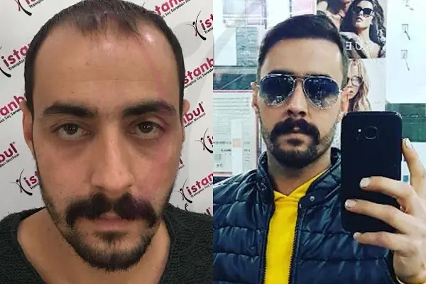İstanbul Transplus Saç Ekim Merkezi