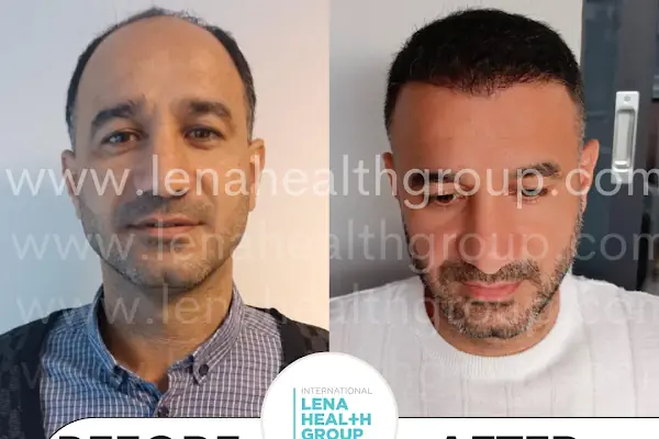 Lena Health Hairtransplant Turkey