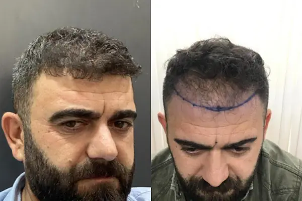 Güneydoğu Saç Ekimi