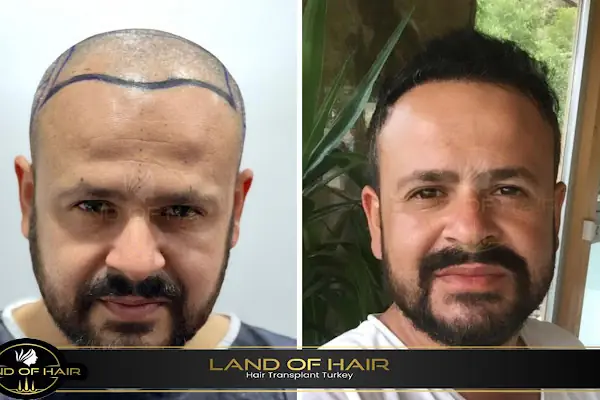 Land Of Hair - Hair Transplant Center / Istanbul Hair Transplant Center in Turkey