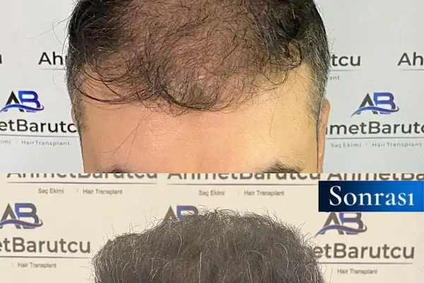 Ahmet Barutcu Saç Ekimi / Hair Transplant