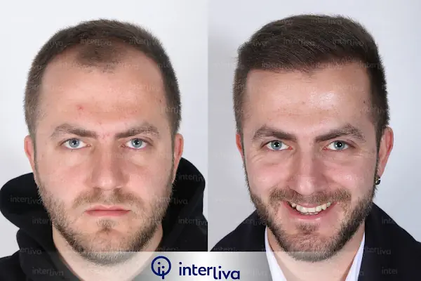 Aziz Aksöz - Hair Transplant Turkey,Hair Transplant İstanbul