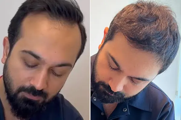 Dr.Gökeşme Hair Transplant