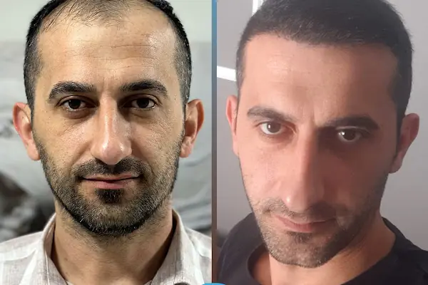 Esteweal Hair Clinic Saç Ekimi