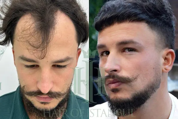 Hair of Istanbul | Hair Transplant
