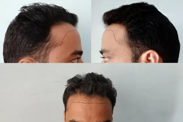 Avicen Hair Transplants, Istanbul