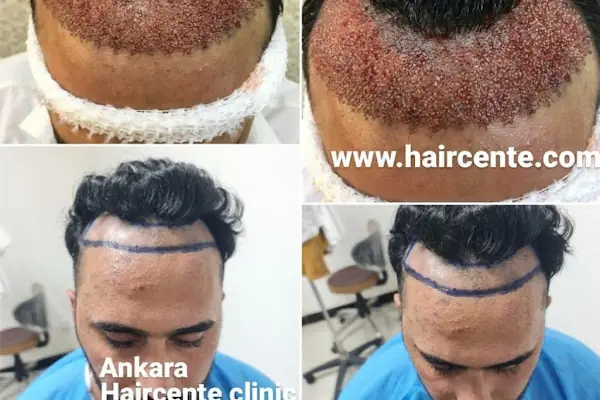 Forest Klinik | Estetik & Saç Ekimi