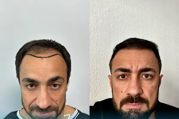 Vialux Hair Transplant | Ankara Saç Ekimi