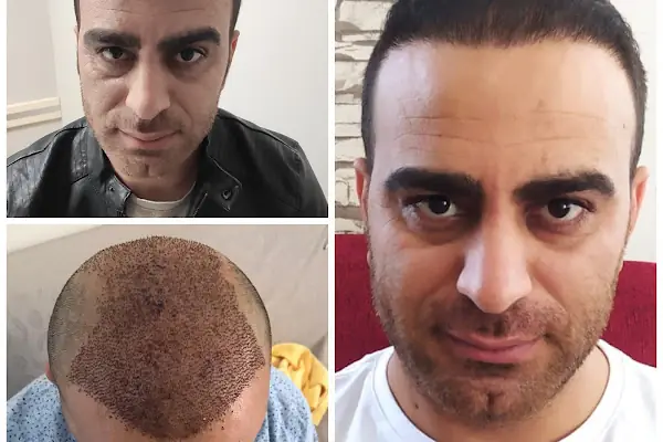Gaziantep Saç Ekim Merkezi