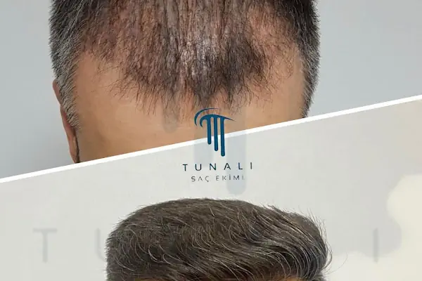 Tunalı Saç Ekimi I Ankara Saç ekimi