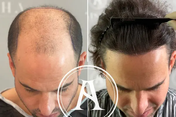 Aisha Hair | Injerto Capilar Turquía | Hair Transplant Turkey