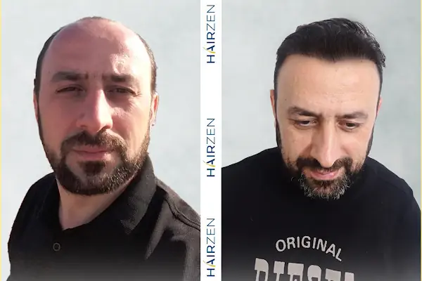 Hairzen Clinic