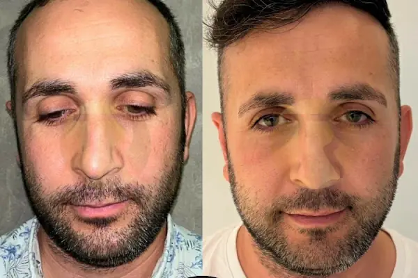 Transes Hair Transplant