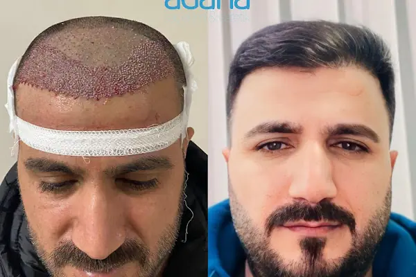 Adana Saç Ekim