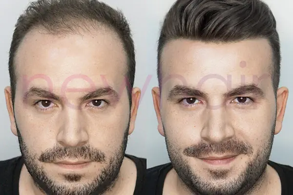 Newhair Bakırköy, Protez saç, Saç Protezi, Saç Ekimi, Kemoterapi, Hair Replacement, Toupee