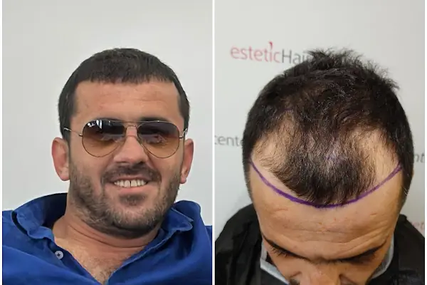 Estetichaircenter Saç Ekimi Saç Simülasyonu Bursa