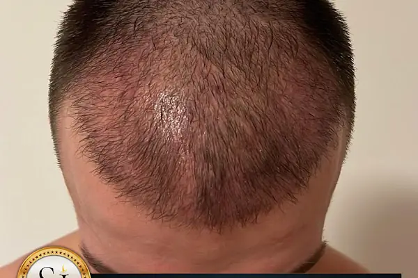Si Hair Transplant in Turkey