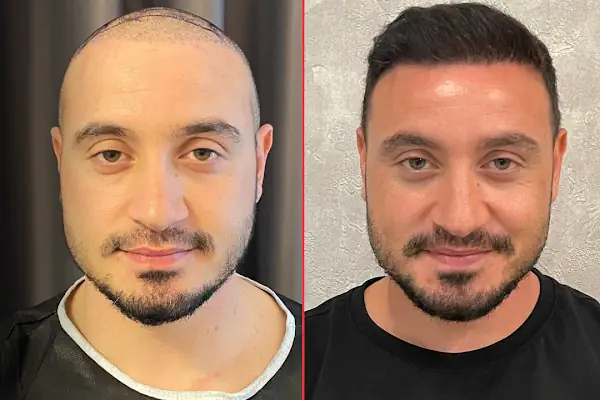 Cüneyt Arman - Saç Ekimi Ve Tedavileri