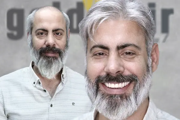 Gold Hair İstanbul - Protez Saç ve Gerçek Saç Merkezi | Real Hair Replacement Center
