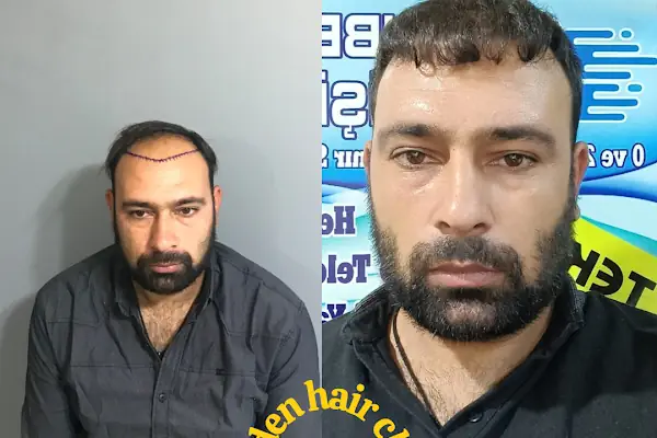 Urfa saç ekim Golden hair clinic