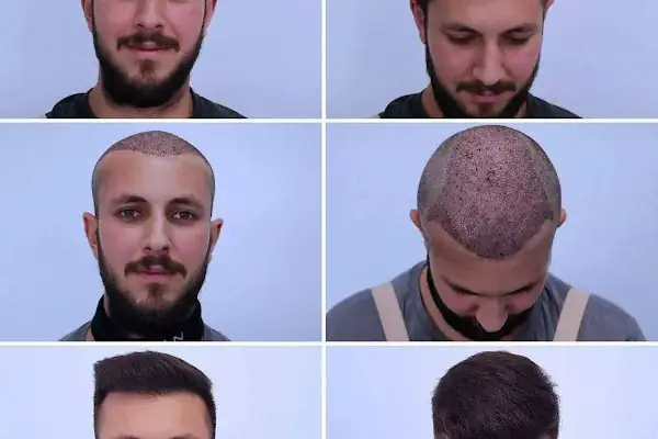 Siverek saç ekim merkezi